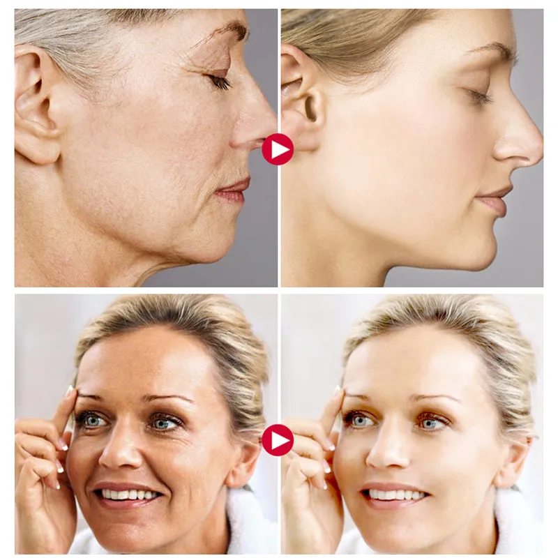 "Snail Secretion Filtrate Cream with Hyaluronic Acid: A Moisturizer for Anti-Wrinkle and Anti-Aging benefits"
